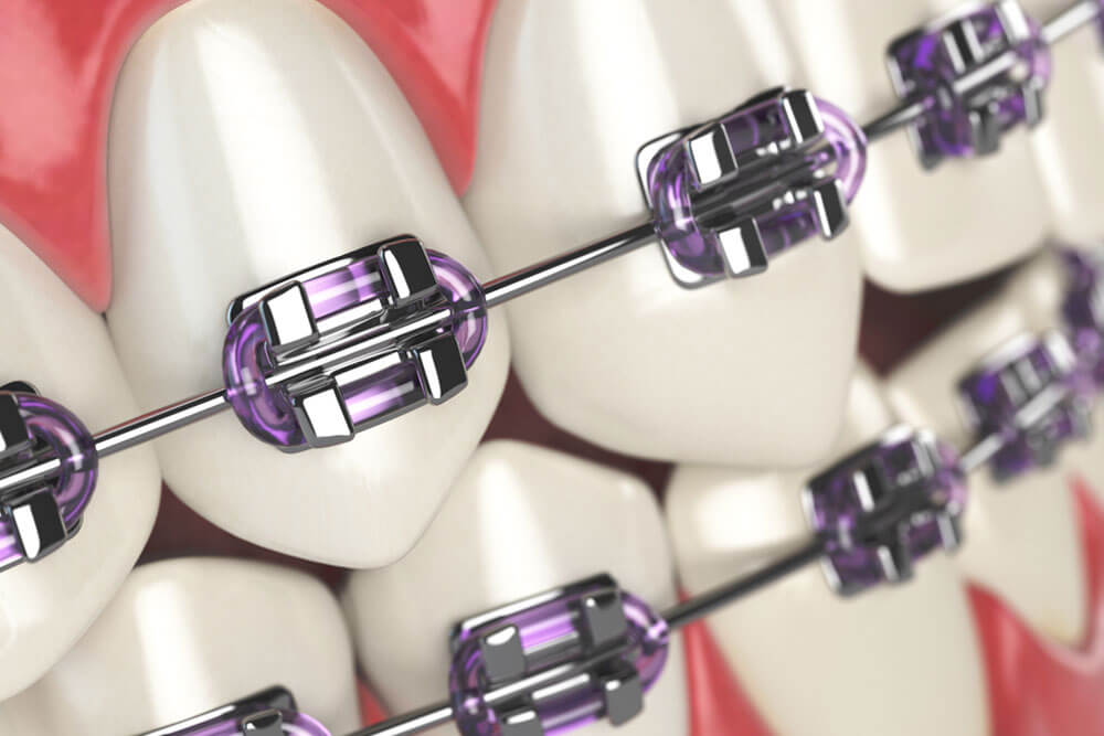 All About Orthodontic Appliances