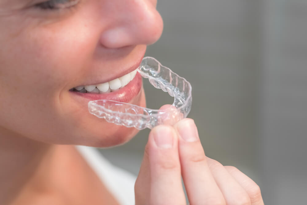 Woman wearing invisible braces aligner